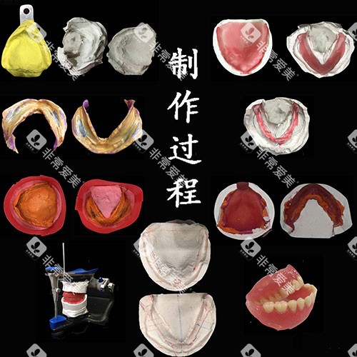 吸附性义齿制作过程示意图