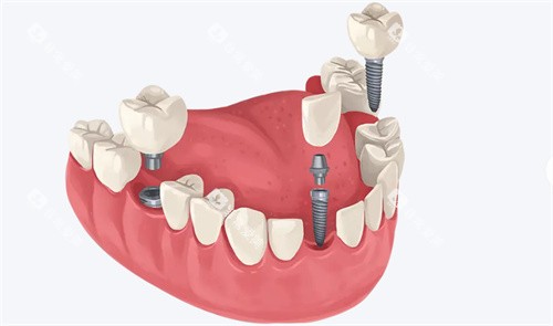 种植牙动画展示 种植牙动画展示