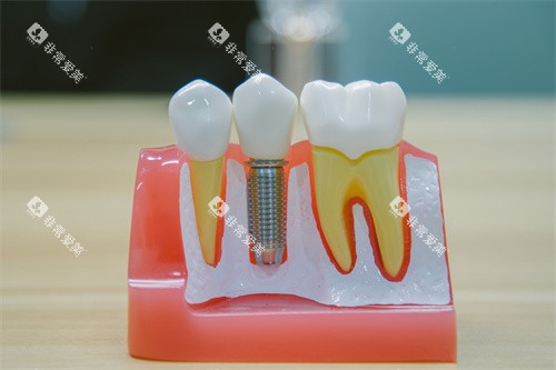 牙科种植牙模型 牙科种植牙模型
