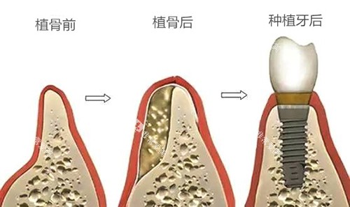 种植牙植骨前后于种植牙后漫画图 种植牙植骨前后于种植牙后漫画图