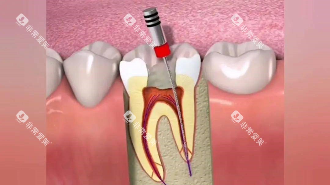 根管治疗的过程示意图 根管治疗的过程示意图