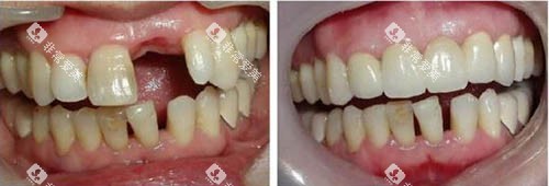 种植牙手术前后图 种植牙手术前后图