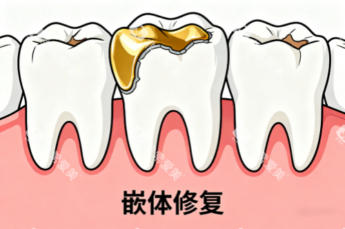 牙齿嵌体修复卡通图 牙齿嵌体修复卡通图