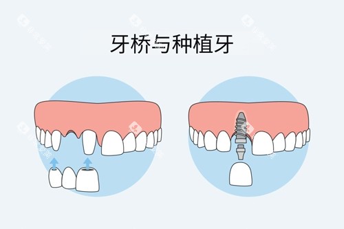 牙冠桥和种植牙对比图