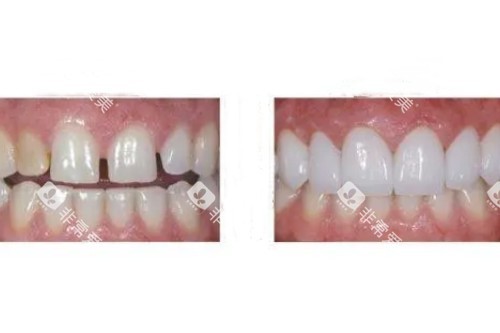 牙齿贴面修复卡通图