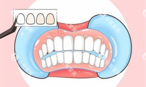 贴面美白示意图