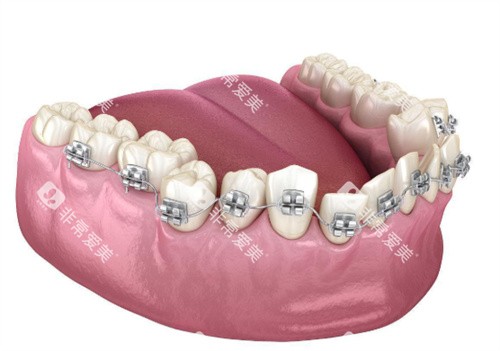 金属牙齿矫正展示图 金属牙齿矫正展示图