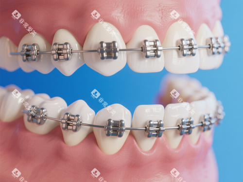 金属托槽牙齿矫正特写