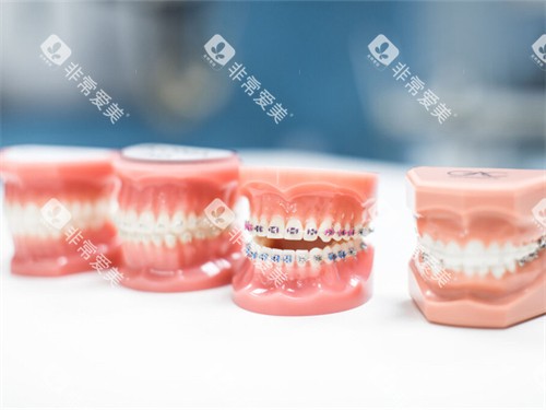 不同的牙齿矫正牙套模型 不同的牙齿矫正牙套模型