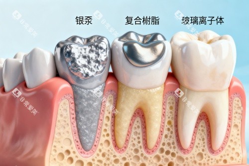 补牙材料卡通图展示 补牙材料卡通图展示