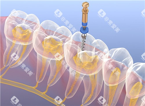 根管治疗透视图