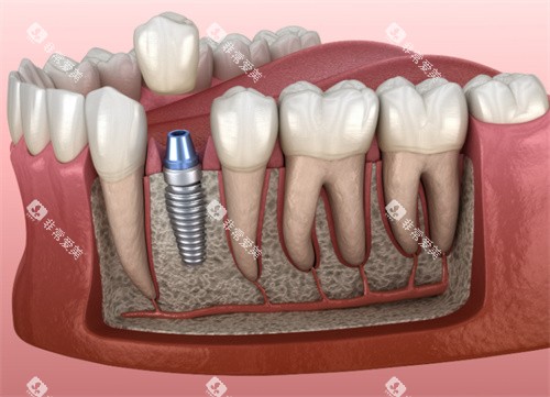 种植牙解剖模型