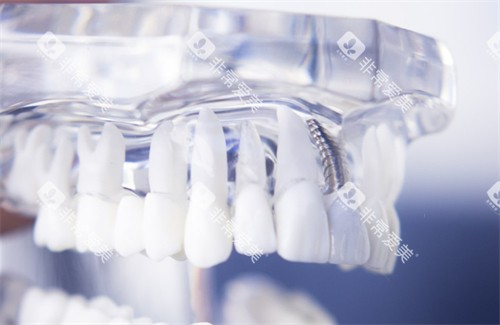 种植牙高清模型图