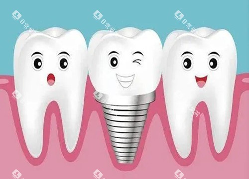 种植牙和真牙卡通示意图