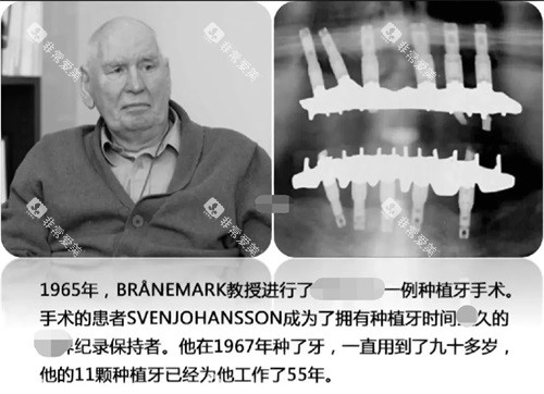 种植牙记录示意图