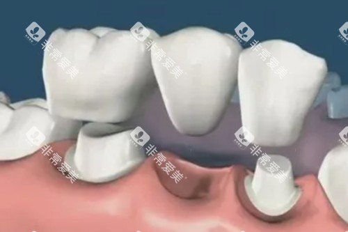 镶牙卡通图片一览
