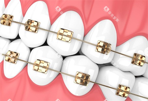 金属牙齿矫正 金属牙齿矫正