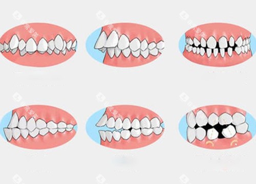 需要牙齿矫正的问题1 需要牙齿矫正的问题1