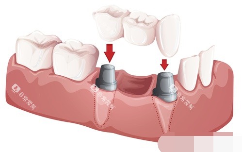 两颗种植牙安装联排牙冠漫画图