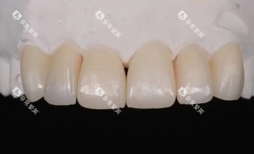 爱迪特全瓷牙示意图