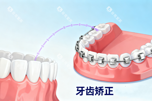 牙齿矫正金属矫正器卡通图