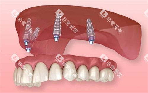 半固定种植牙动画图