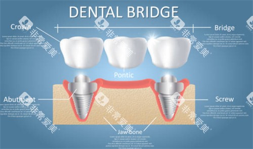 种植牙连桥冠示意图