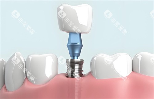 种植牙模型结构图片