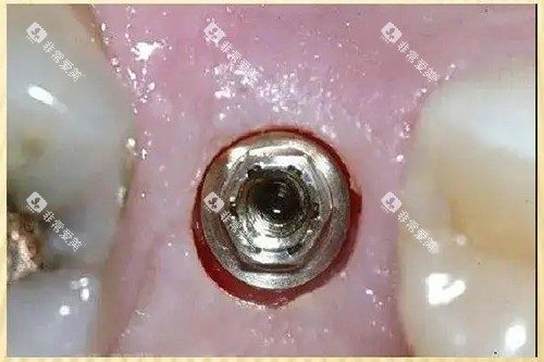 微创种植牙打孔示意图 微创种植牙打孔示意图