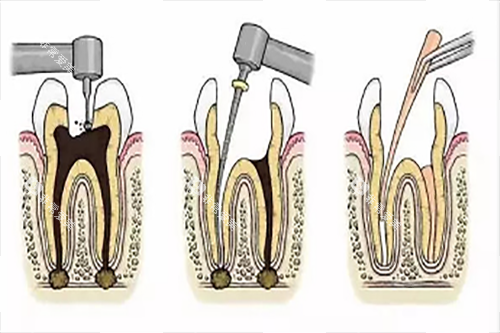根管治疗步骤1 根管治疗步骤1