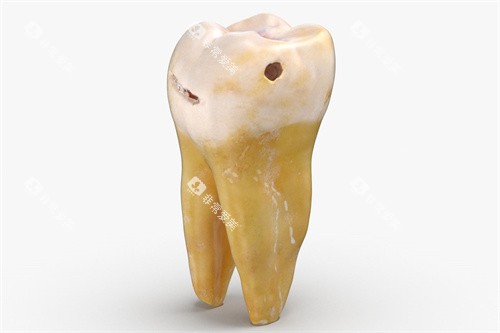 龋坏的六龄齿 龋坏的六龄齿