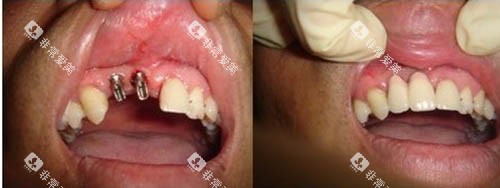 种牙前后照片 种牙前后照片