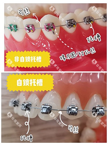 牙齿矫正自锁和非自锁牙套区别 牙齿矫正自锁和非自锁牙套区别