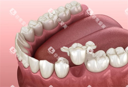 牙齿修复动画展示图 牙齿修复动画展示图