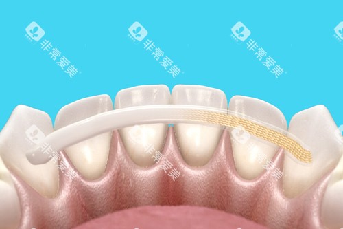 牙齿固定卡通图 牙齿固定卡通图