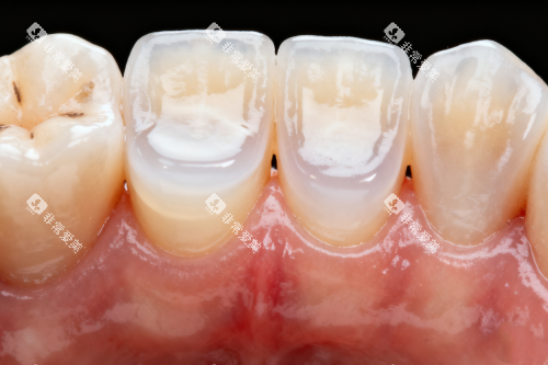 牙齿发黄图片展示
