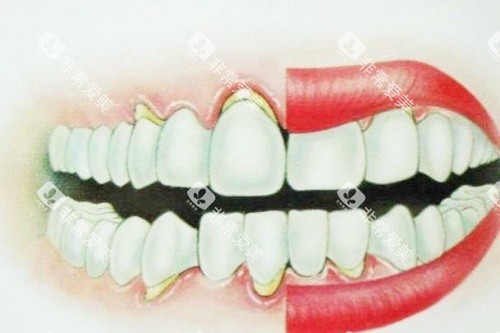 正常牙齿与牙龈萎缩牙齿卡通对比图 正常牙齿与牙龈萎缩牙齿卡通对比图