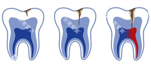 牙釉质牙齿龋坏不同程度 牙釉质牙齿龋坏不同程度
