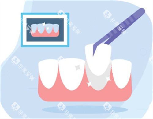 牙齿修复图 牙齿修复图