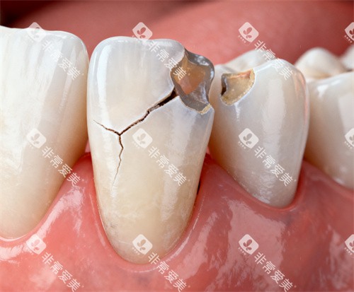 牙齿折裂 牙齿折裂