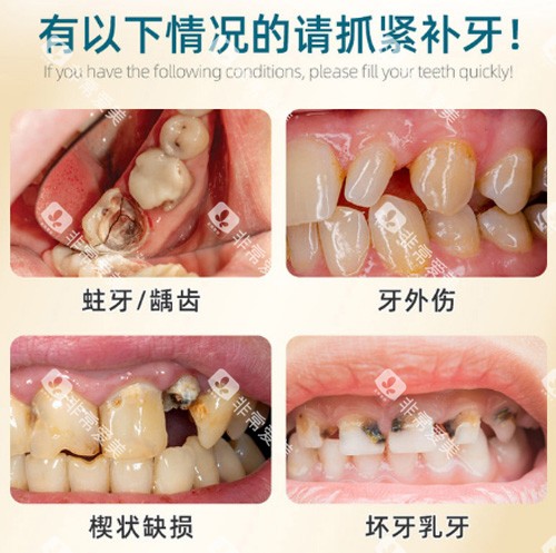 补牙适应症展示