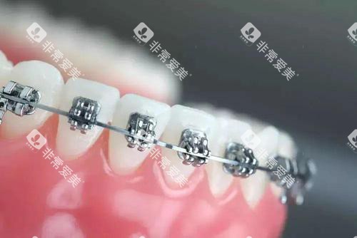 牙齿矫正牙套金属托槽矫正