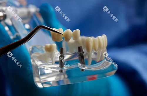 种植牙照片 种植牙照片