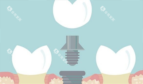 组成种植牙的三部分动画展示 组成种植牙的三部分动画展示