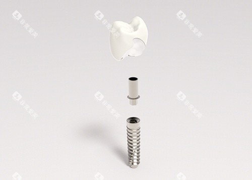 种植牙图片 种植牙图片