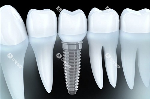 单颗种植牙图示 单颗种植牙图示