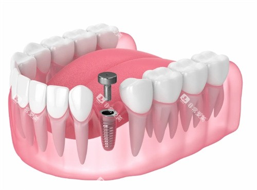 种植牙基台安装透视动画
