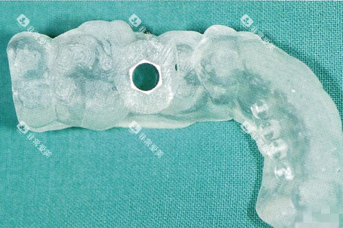 后牙种植牙导板