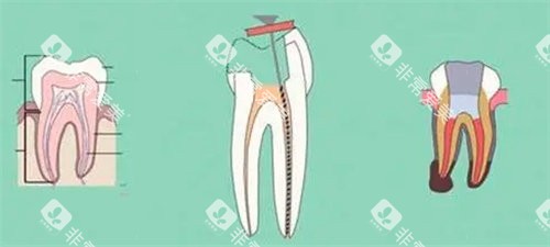 牙齿受损 牙齿受损