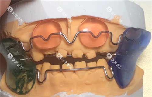 法兰克3矫正器模型实拍